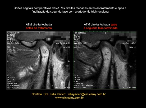 35 ressonancia comparativadir 2int