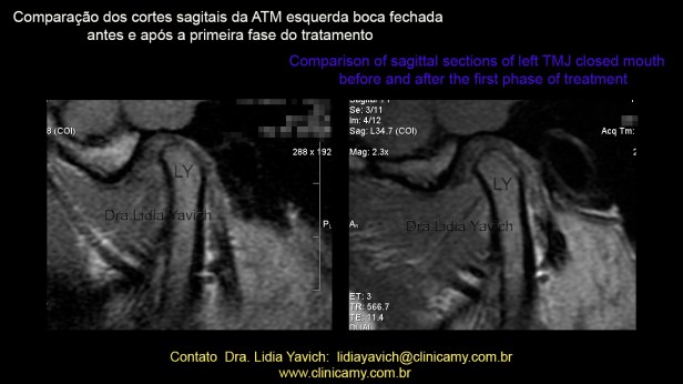 39 RNM AFTER TREATMENT 2