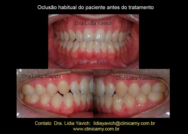 5 DENTES