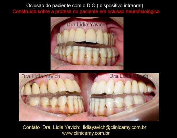 13 DENTES COM ORTESE