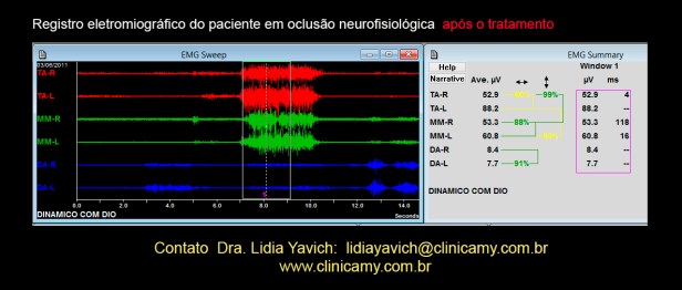 14 ELETROMIOGRAFIAS COM o DIO