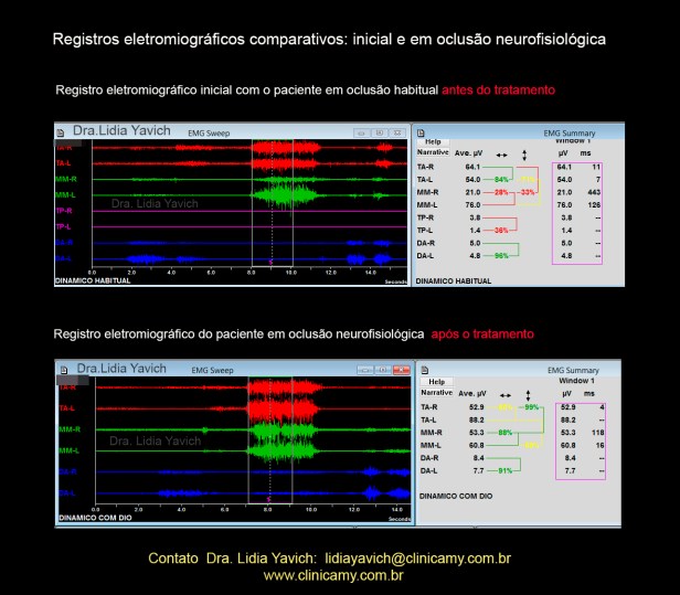 15 ELETROMIOGRAFIAS COMPARATIVAS