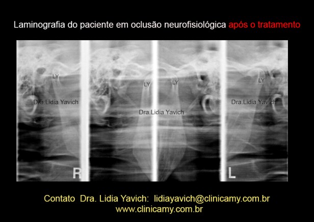 20 LAMINOGRAFIA COM O DIO