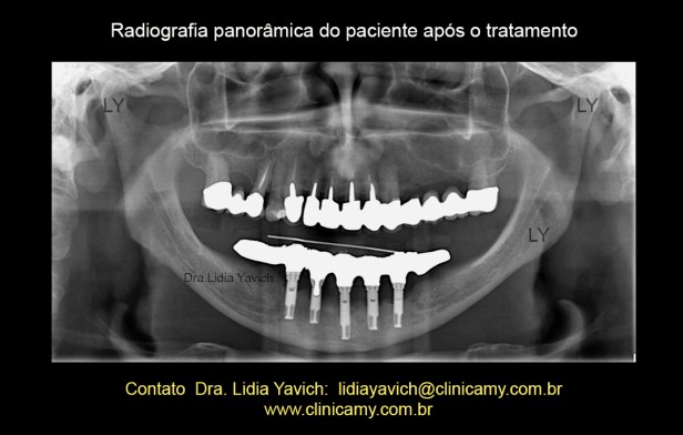 22 PANORAMICA COM ORTESE
