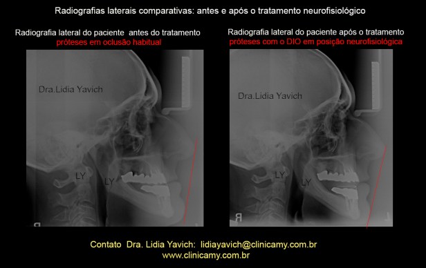 26B LATERAIS COMPARATIVAS LINHA