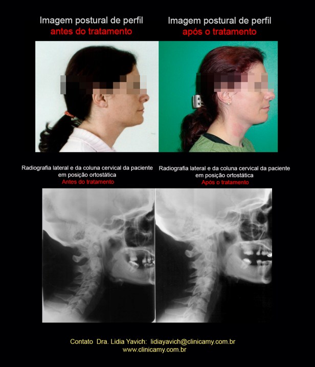 17 COLUNA E PERFIL COMP