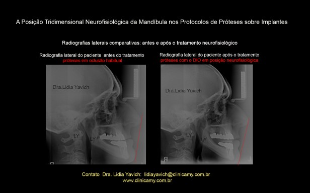 26B LATERAIS COMPARATIVAS LINHA
