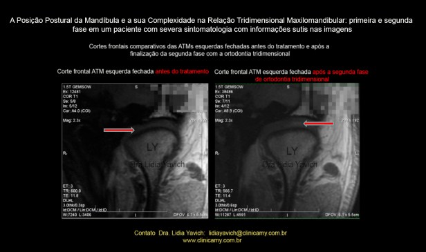 31 ress comparativa frontal esq 1 flecha