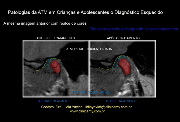 41 RNM AFTER TREATMENT cor