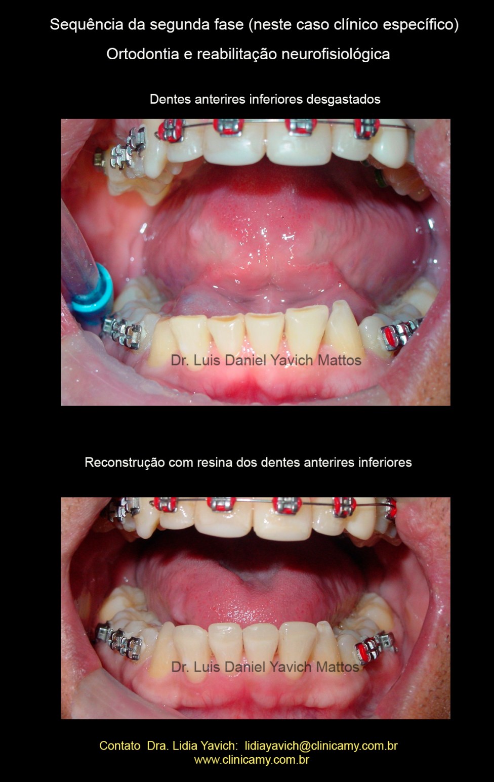 20 RESINAS INFERIORES