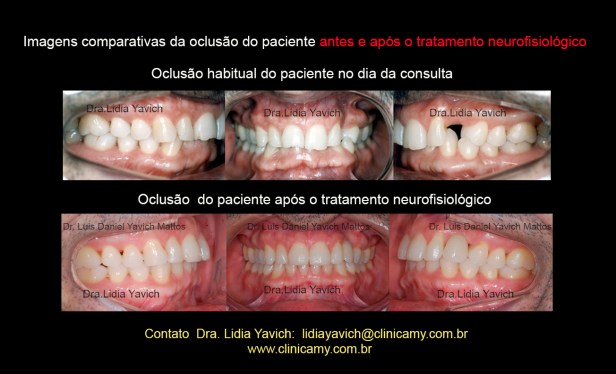 23 DENTES FINAL COMPARATIVOS