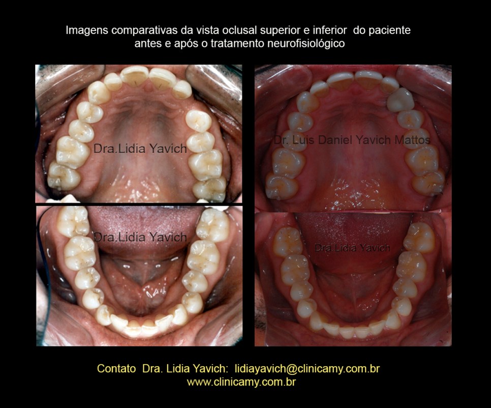 25 OCLUSAIS FINAIS COMPARATIVAS