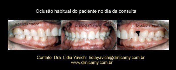 3 DENTES