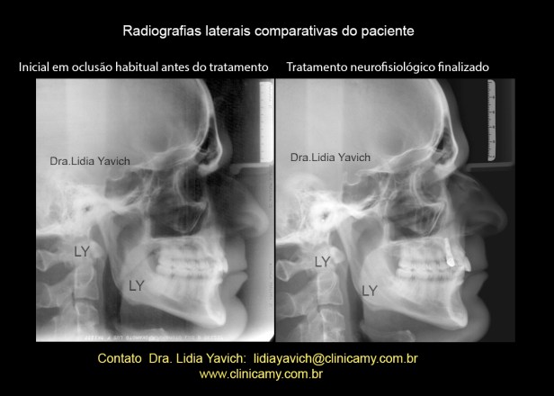 30 COMPARAÇAO PERFIS