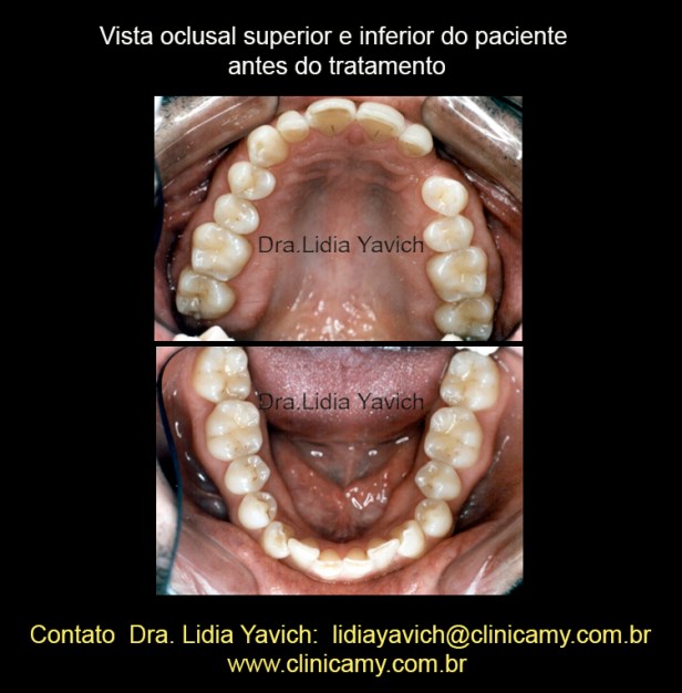 4 OCLUSAL SUP E INF