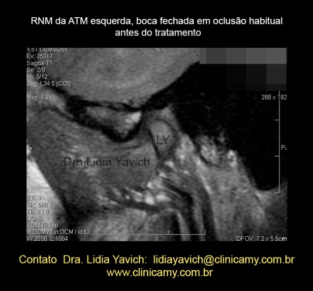 11 RESS ESQ  2 BOCA FECHADA