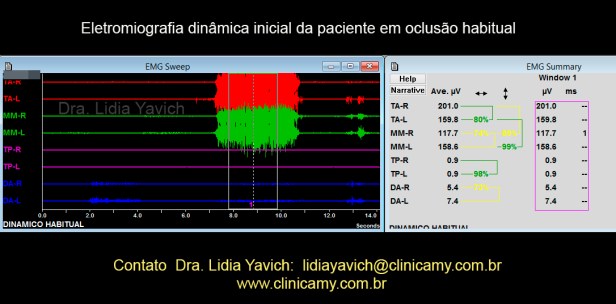 11A eletromiografia dinãmica habitual