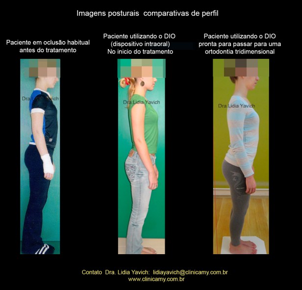 22 Comparativas de perfil com e sem ortese