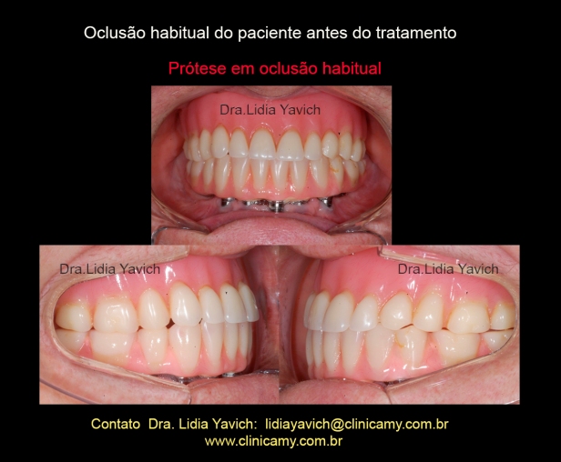 3 DENTES INIC PROT FRONTAL