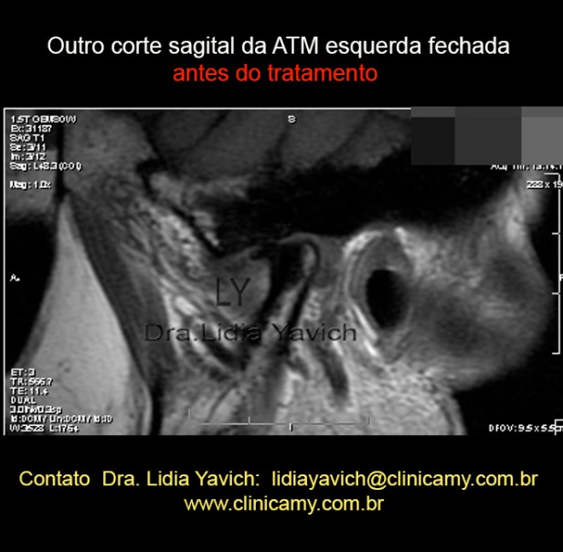 13A RNM  ESQ  INICIAL