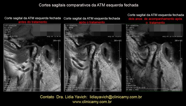 RESS COMP SAGITAL ESQ 2016 MODIFICADO