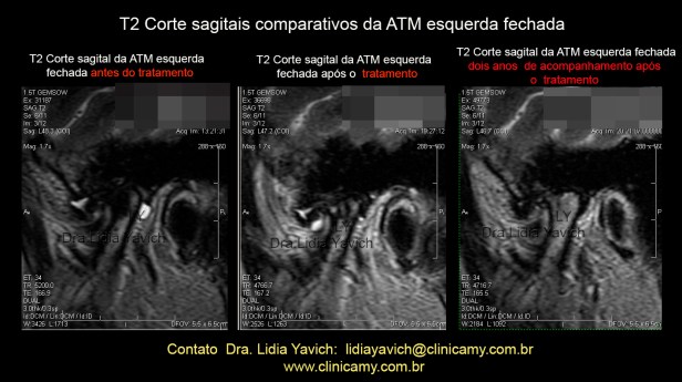 sagitais comparativas T2 modificado