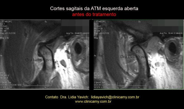 14B RNM INICIAL esquerda aberta