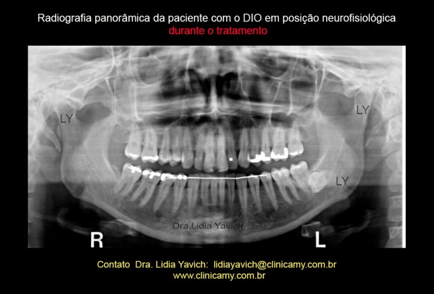 20 PANORAMICA COM ORTESE
