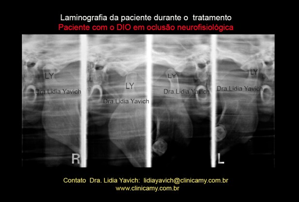 21 LAMINOGRAFIA COM ORTESE