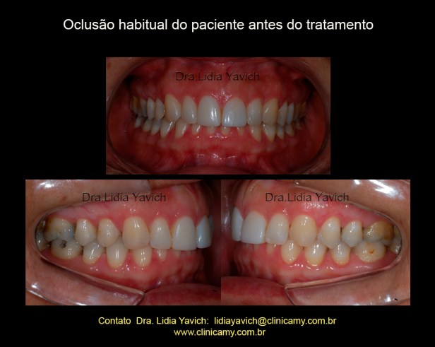 3 DENTES INICIAIS
