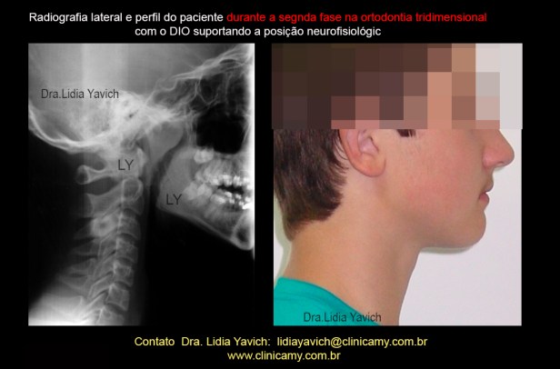 30 A PERFIL E RAD LATERAL ORTO