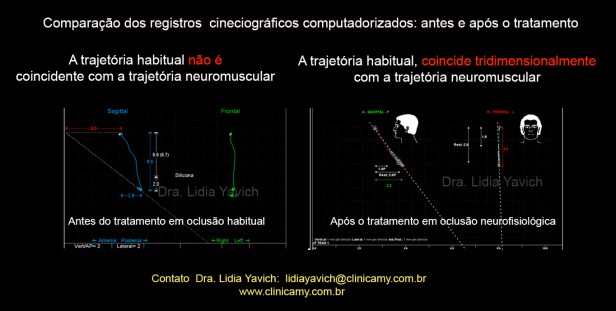 39 jaw trackwe  comparativoa