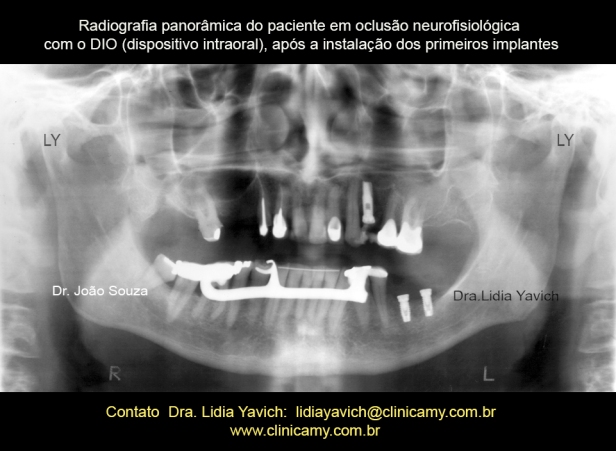 24-radiografia-implante-1