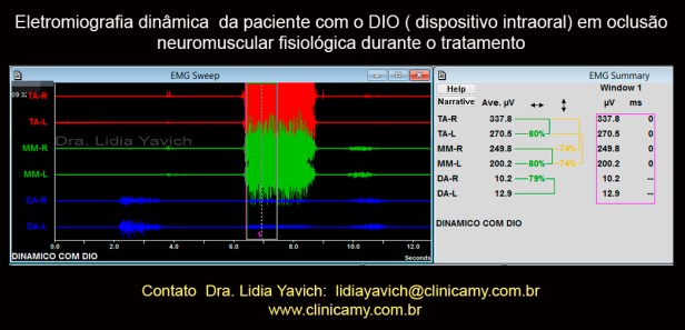 22A eletromiografia com o DIO