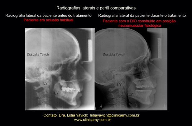 25 rad lateral e perfil