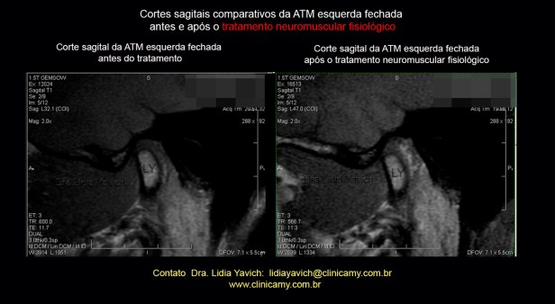 50 ress esqu comparativa 1