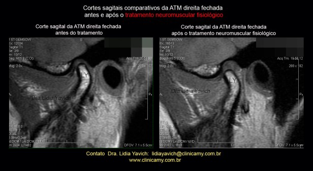 51 b ress direita comparativa 1