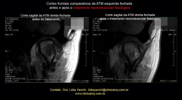 53 ress esquerda frontal comparativa 1