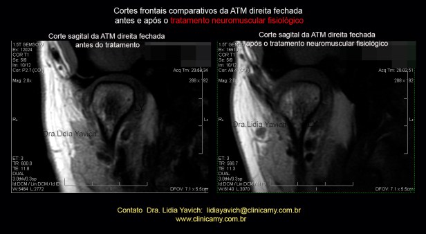 54 ress direita frontal comparativa 1