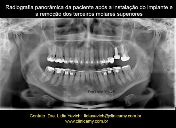 56 PANORAMICA COM O IMPLANTE