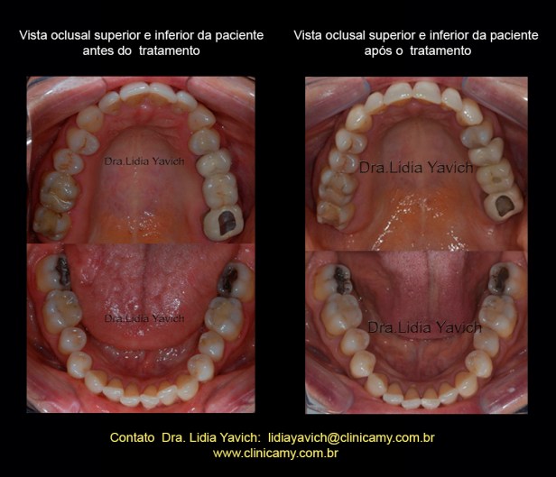 72 comparação OCLUSAIS FINAIS