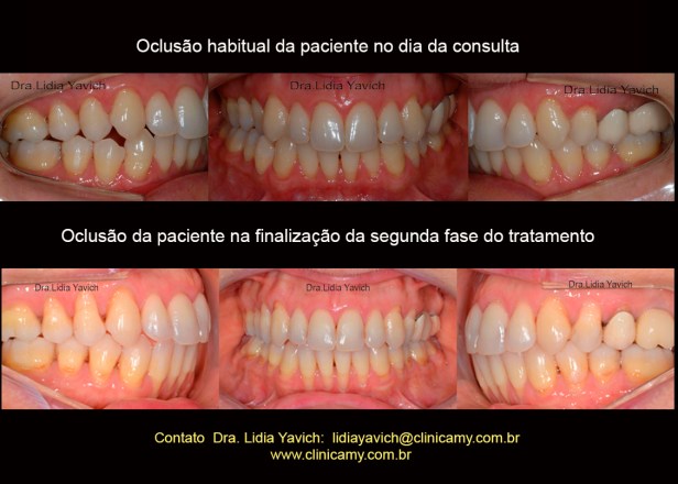 72 OCLUSÃO Icomparativas