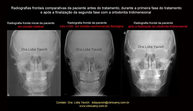 75 TELEFRONTAIS COMPARATIVAS