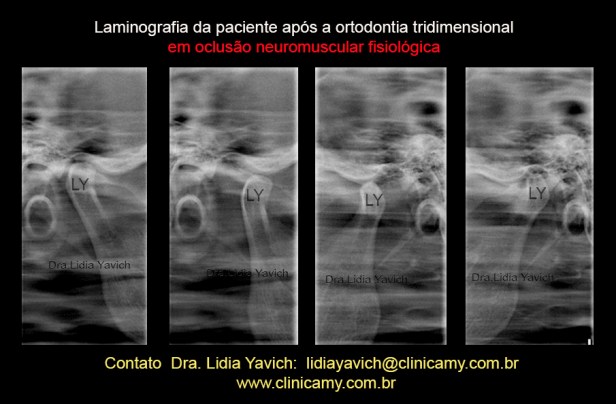 35 LAMINOGRAFIA FINAL