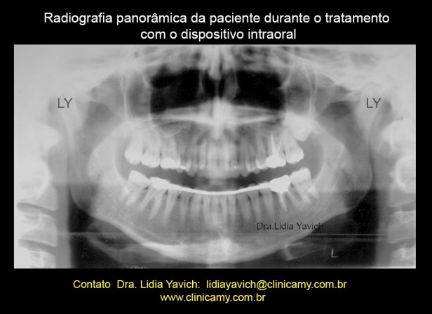 9D PANORAMICA COM ORTESE