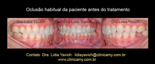 3 dentes inic