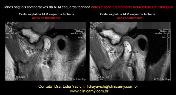 35 rnm comparativas 1